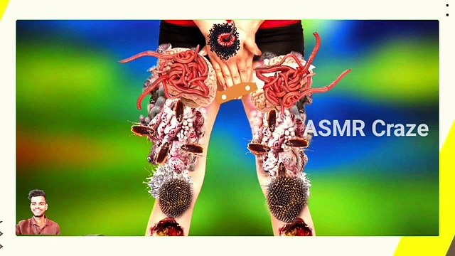 Asmr remove leg worm |ASMR Remove Worm Infected Severely Injured Legs