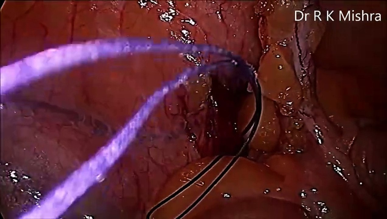 Laparoscopic Appendectomy by Dr. R. K. Mishra