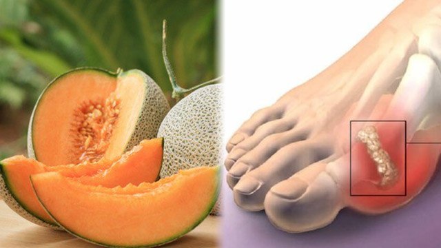 Musk Melon In High Uric Acid: Gout Swelling Foot से लेकर Pain ठीक करने में Benefits | Boldsky
