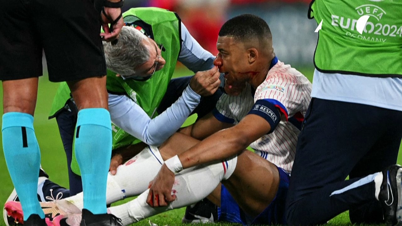 Mbappe Sufre UnaFractura En La Nariz