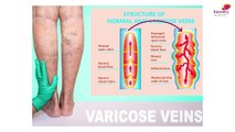 Endovenous Laser Ablation of Varicose Veins