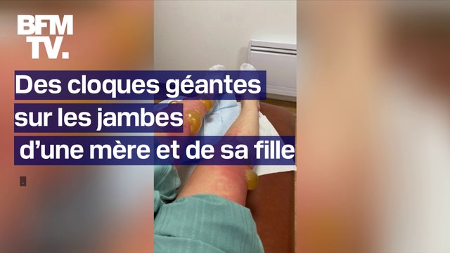 Des cloques géantes apparaissent sur les jambes d’une mère et de sa fille après une virée au bord d’un lac