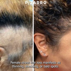 What Does Female Stress Hair Loss Look Like?