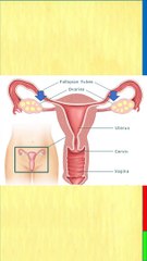 fallopian tube blockage || Fallopian tube क्यों बंद होती है || Fallopian tube कैसे ठीक करें ||