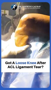 Fix Loose Knee Ligaments With ACL Ligament Surgery in Patna, Bihar - Dr Ashwini Gaurav