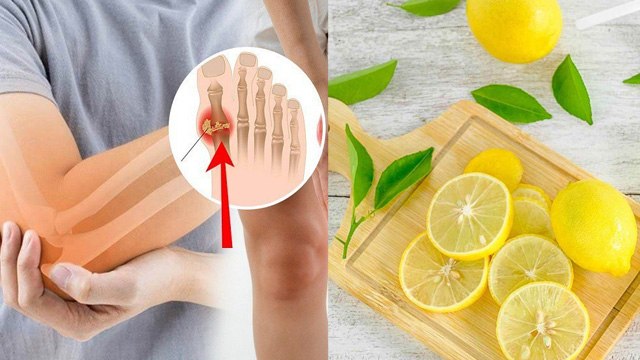 Lemon In Uric Acid: High Uric Acid Me Nimbu Khana Chahiye| Gout Swelling To Purine Filtration...
