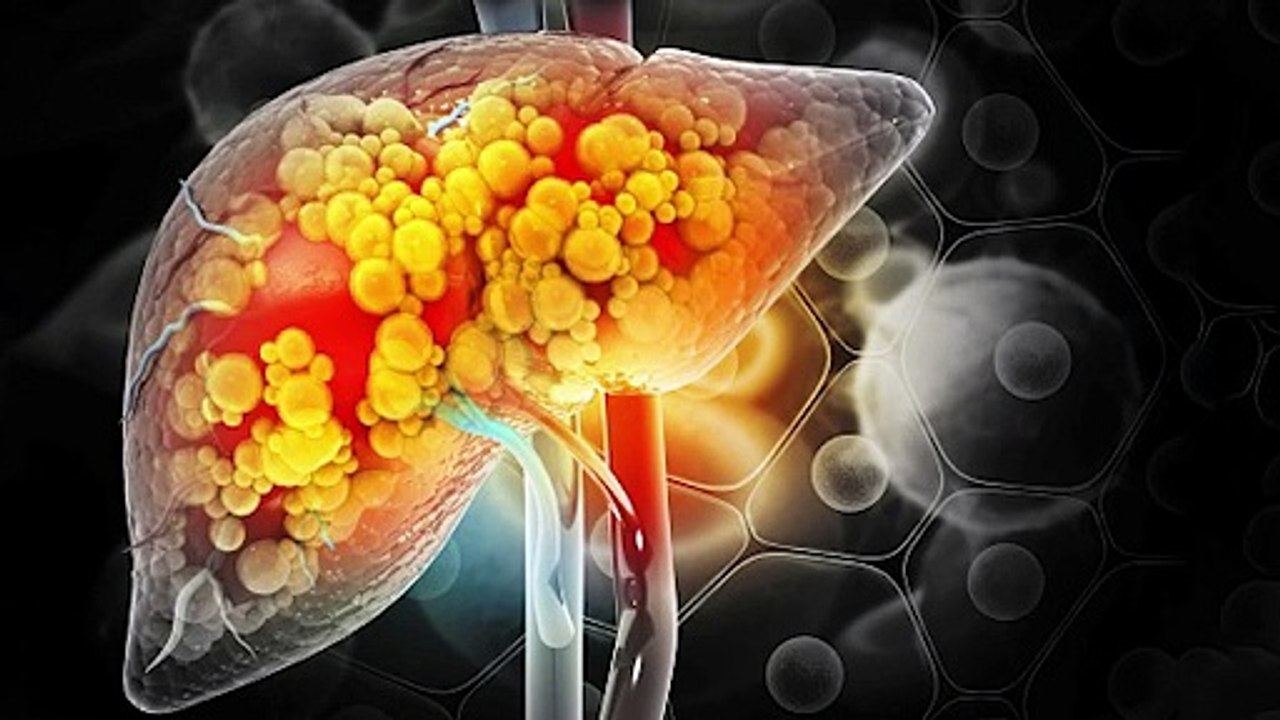 How to treat & reserve fatty liver جگر کی چربی کو کیسے ختم کرے