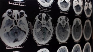2nd Canadian Scientist Says an Investigation Into a Mysterious Brain Illness Was Shut Down
