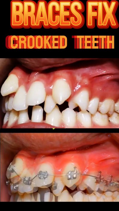 ऑर्थोडॉन्टिक फिक्स |Orthodontic fix| Teeth straightening |Braces Fix| #OrthodonticTreatment #TeethStraightening #BracesForAdults |Ortodontik tuzatish #Viral #Shorts #shortsfeedsClearAligners #SmileDesign