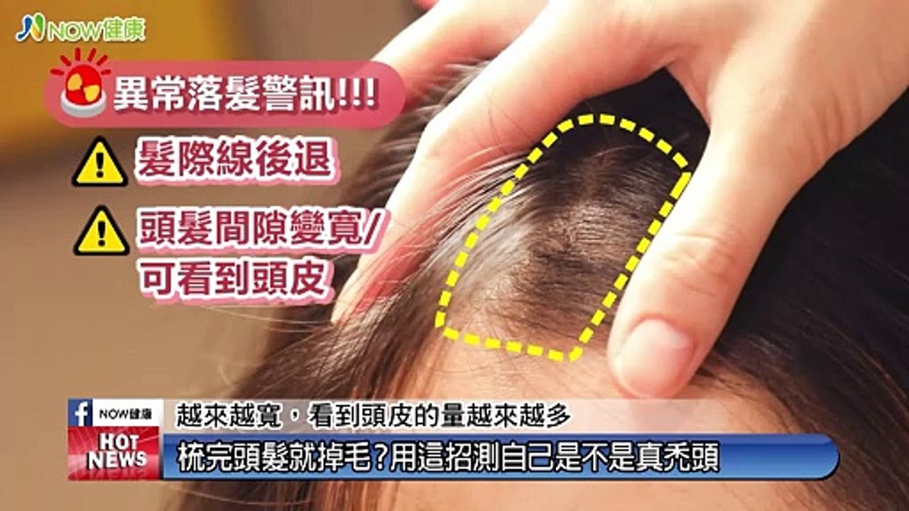 異常落髮高危險群別煩惱！ 育髮注入增生療法創新突破｜越L’EXCELLENCE醫療美學健康管理診所 - 新聞影片｜遠大整合行銷