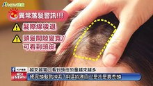 異常落髮高危險群別煩惱！ 育髮注入增生療法創新突破｜越L’EXCELLENCE醫療美學健康管理診所 - 新聞影片｜遠大整合行銷