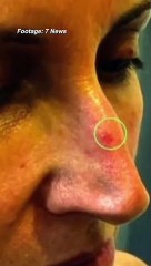 Sunrise host Natalie Barr reveals skin cancer diagnosis