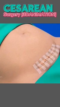 Surgery |C-SECTION|3D animation الجراحة|القسم القيصري|رسوم متحركة ثلاثية الأبعاد सर्जरी|सी-सेक्शन|3डी एनिमेशन 手術|帝王切開|3Dアニメーション সার্জারি|C-SECTION|3D অ্যানিমেশন C section delivery short video