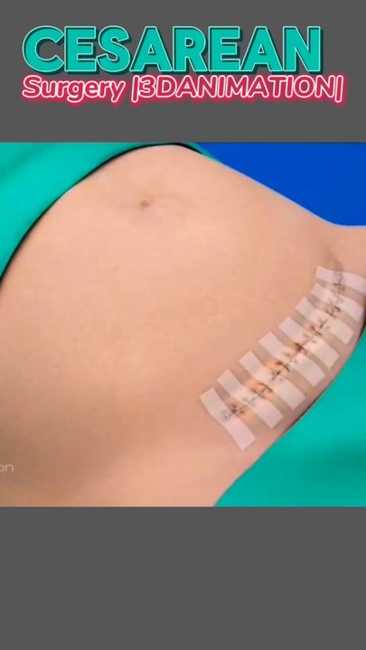 Surgery |C-SECTION|3D animation الجراحة|القسم القيصري|رسوم متحركة ثلاثية الأبعاد सर्जरी|सी-सेक्शन|3डी एनिमेशन 手術|帝王切開|3Dアニメーション সার্জারি|C-SECTION|3D অ্যানিমেশন C section delivery short video