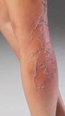 Sclerotherapy Procedure|मकड़ी नस️ स्क्लेरोथेरेपी प्रक्रिया|| إجراء العلاج بالتصليب| স্ক্লেরোথেরাপি পদ্ধতি| #viral#Shorts#shortsfeeds #drsadia1446