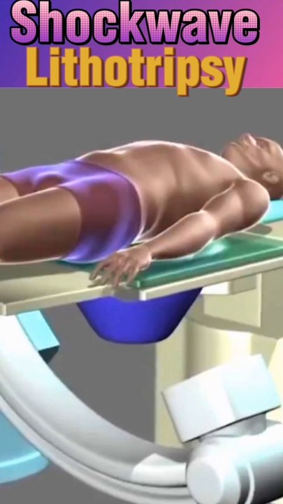 Shockwave lithotripsy animation shorts शॉकवेव लिथोट्रिप्सी एनीमेशन शॉर्ट्स    شورت الرسوم المتحركة لتفتيت الحصوات بالمستخدمين लिथोट्रिप्सी प्रक्रिया  How lithotripsy works|  Lithotripsy procedure| viral #Shorts #shortsfeeds  #3danimation #DrSadia1446 #Kid