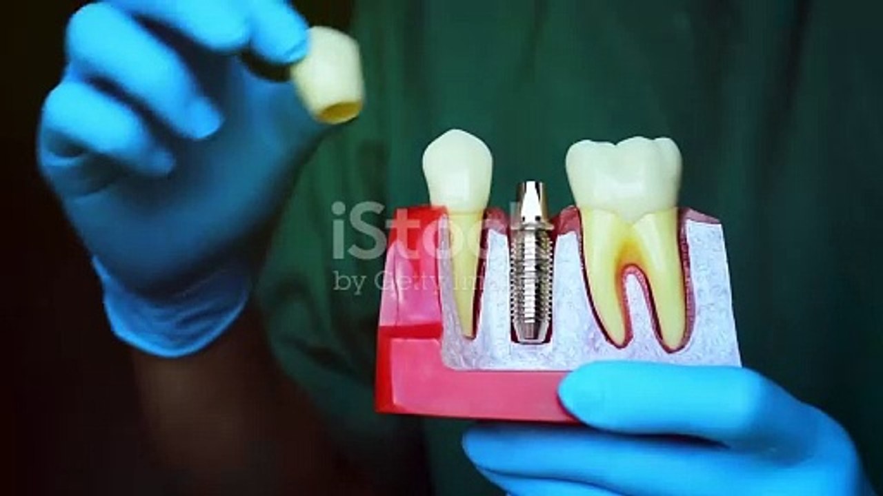 dental implants boise id Modern Dental video Dailymotion