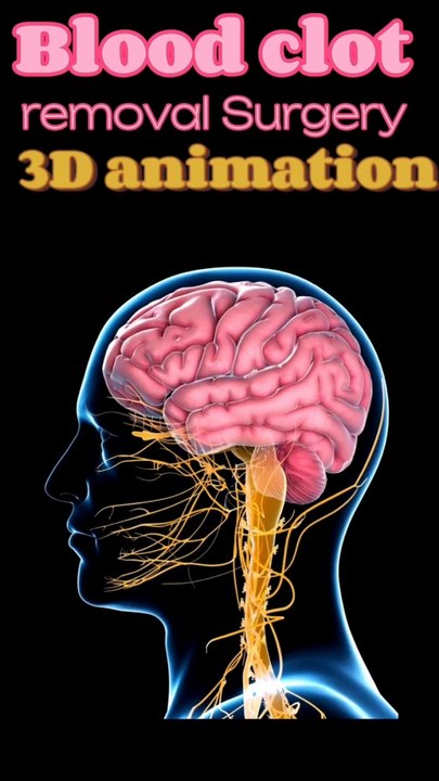 Blood clot removal animation| रक्त का थक्का हटाने का एनीमेशन الرسوم المتحركة لإزالة جلطة الدم রক্ত জমাট অপসারণ অ্যানিমেশন 血塊清除動畫 Brain Clot Surgery Animation     रक्त का थक्का जमने का एनीमेशन  | #Viral #Shorts #Shortfeeds #drsadia1446  #Doctor