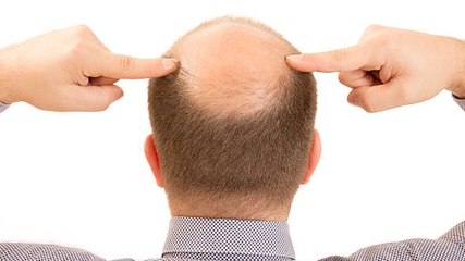 ¿Miedo A Quedarte Calvo? Desmentimos Estos Mitos