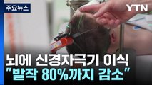 10대 뇌전증 환자 뇌에 처음으로 신경자극기 이식...