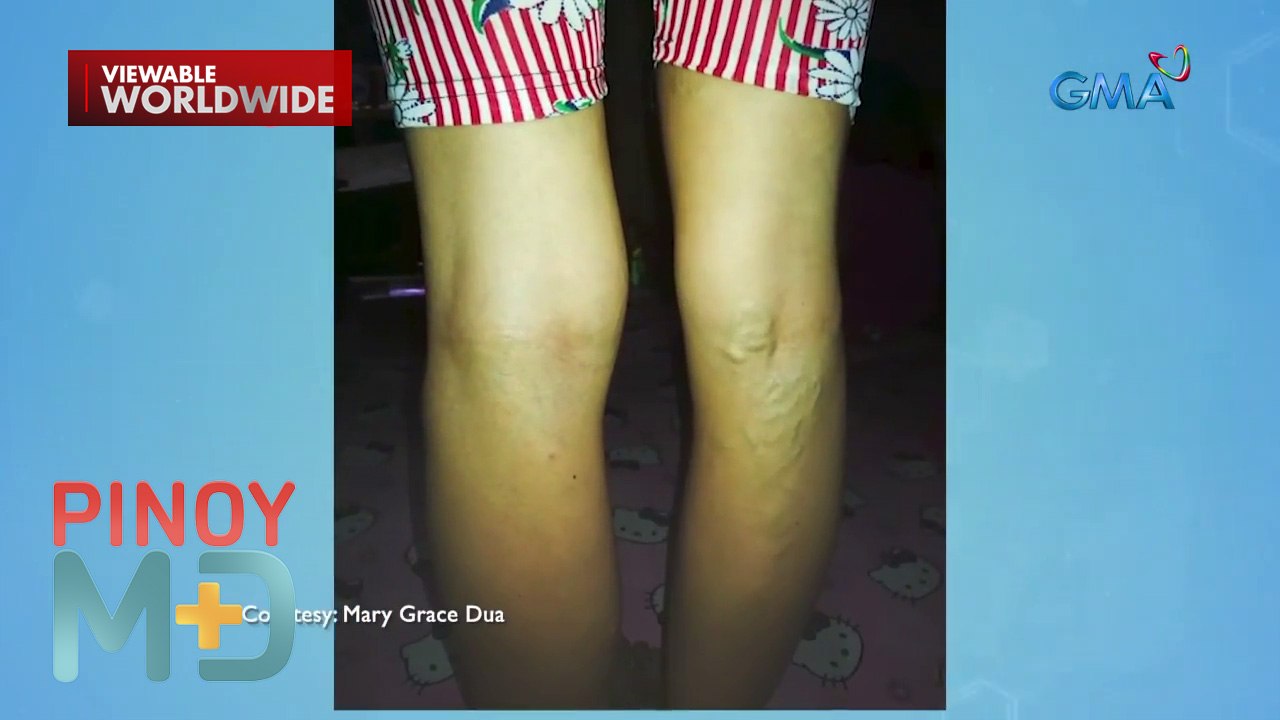 Home remedies para sa pagkakaroon ng varicose veins, alamin! | Pinoy MD
