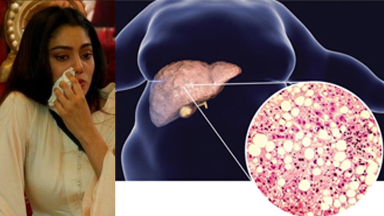 Bigg Boss OTT 3: Sana Makbul को Non Alcoholic Hepatitis, Symptoms, Reason & Treatment | Boldsky
