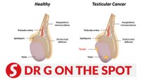 EP229: Testicle cancer, treatment and teens | PUTTING DR G ON THE SPOT