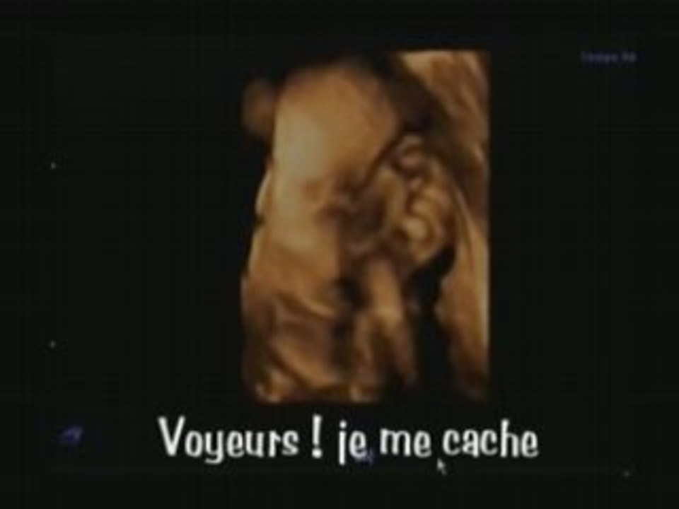 Echographie 3D