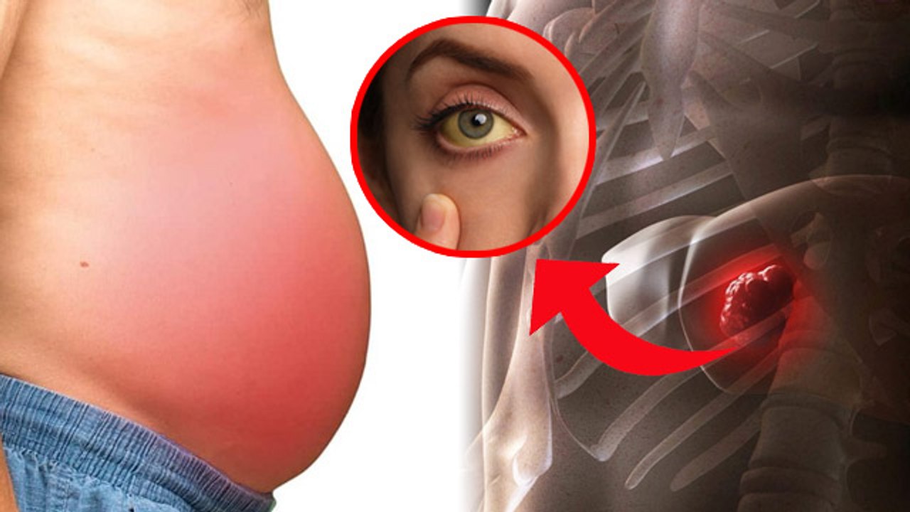 Hepatomegaly Kya Hai: Liver Swelling Symptoms: Causes, Pain, Problem, Treatment In Hindi