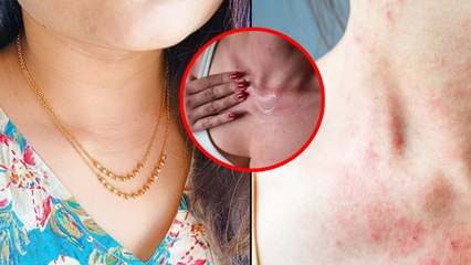 Gold Chain Allergy: Neck Rash Reason, Skin Irritation, Best Cream To Apply|Boldsky