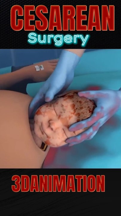 सेक्शन एनिमेशन| Cesarean Section animation|الجراحة القيصرية| ||C Section Shorts #shorts #shortsfeeds  #3danimation #CSECTION Surgery  #viral  #csectionscar  #drsadia1446 #medicalinfo  #shortsfeed #medical information  #bluefilmdikhaiye #3danimationsurge