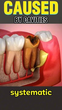 Cavity risks Tooth decay dangers Oral health issues मौखिक स्वास्थ्य संबंधी समस्याएं قضايا صحة الفم Dental care tips Cavity prevention Healthy smile