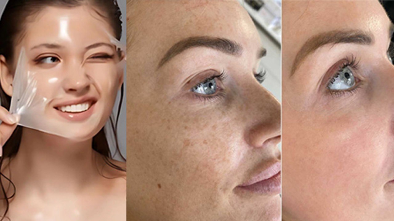 Chemical Peel Kya Hota Hai, For Acne Scars Before And After, Treatment, Process & Price Details...