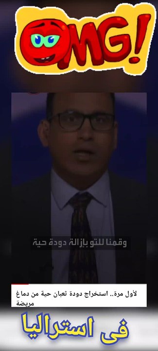 العلماء يجدون دودة فى دماغ سيدة