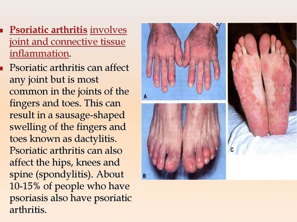 Psoriasis