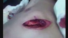 Surgery Operation #2