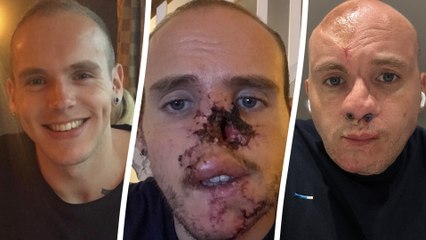 Man has his nose rebuilt using ribs after it was ripped off by dog