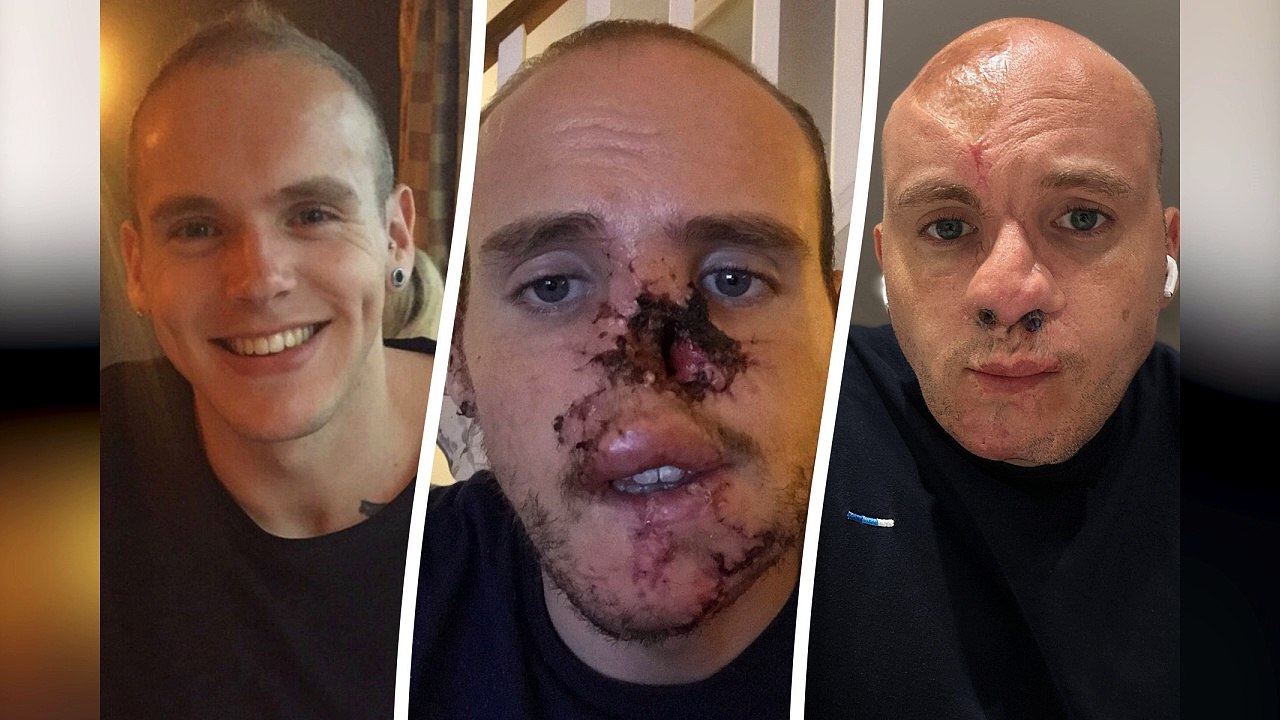 My dog mauled my nose off while I was having an epileptic seizure