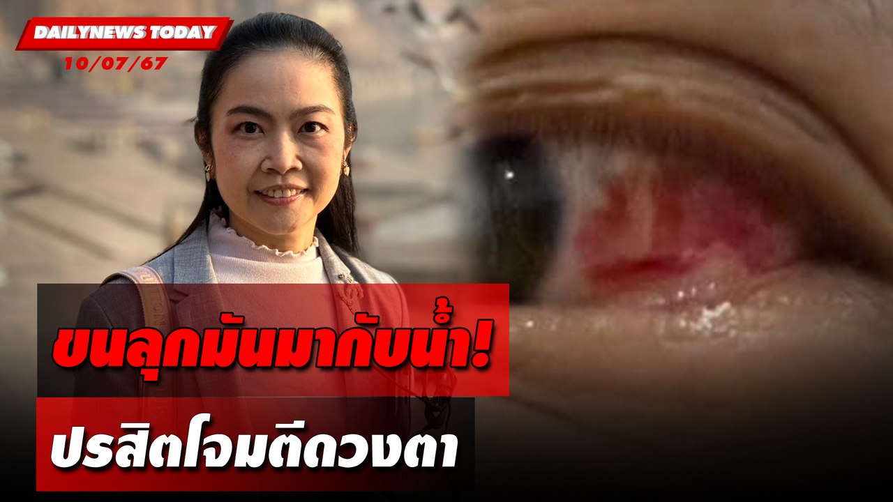 ขนลุกมันมากับน้ำ! ปรสิตโจมตีดวงตา | DAILYNEWSTODAY 10/07/67
