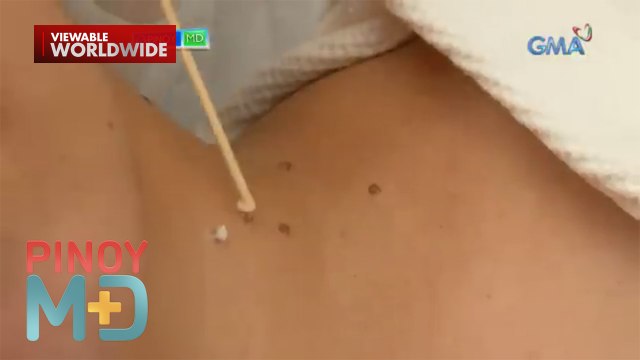 Ano nga ba ang dahilan sa pagkakaroon ng kulogo sa balat? | Pinoy MD