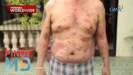 Sanhi ng pagkakaroon ng sakit na Psoriasis, alamin! | Pinoy MD