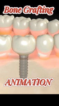 Bone Grafting Techniques अस्थि ग्राफ्टिंग तकनीक تقنيات تطعيم العظام #viral #shorts #Shortsfeeds #DrSadia1446 #BoneGrafting #DentalAnimation #OrthopedicSurgery #BoneGraftingSurgery