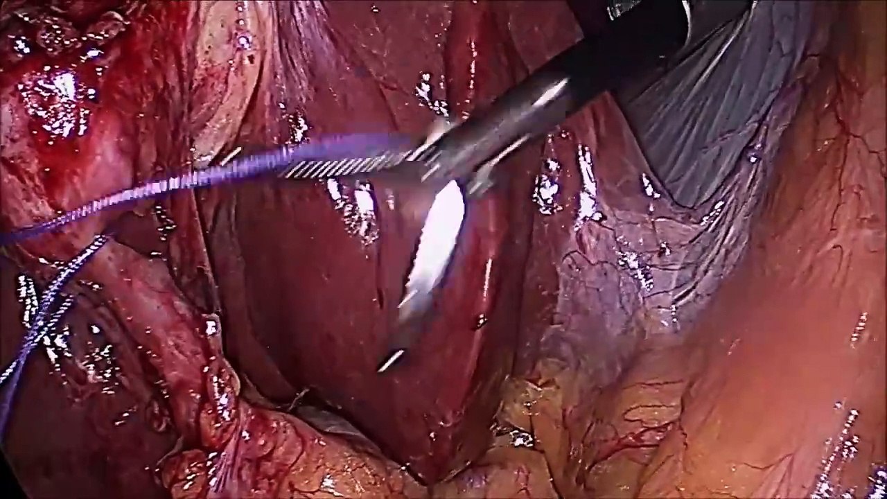 Laparoscopic Cholecystectomy for Contracted Gallbladder with Solitary Large Stone