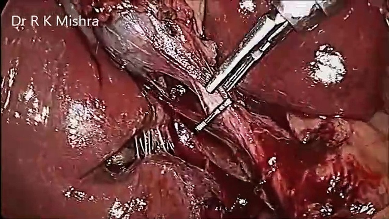 Laparoscopic Cholecystectomy for Gall Stone Full Video