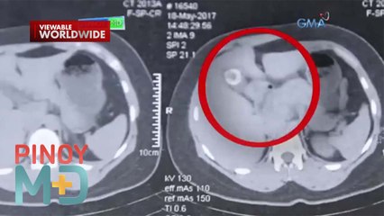 Pagkakaroon ng gallstones o bato sa apdo, paano maiiwasan? | Pinoy MD