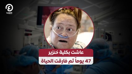 عاشت بكلية خنزير 47 يوماً ثم فارقت الحياة