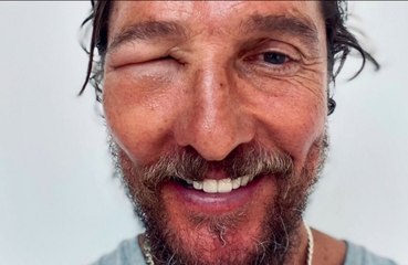 Matthew McConaughey, occhio gonfissimo: cos'è successo