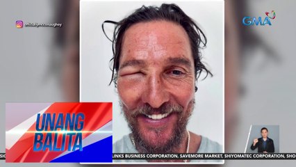 American actor Matthew McConaughey, namaga ang mukha dahil sa bee sting | Unang Balita