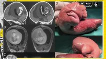 Descubren feto en el cráneo de un bebé