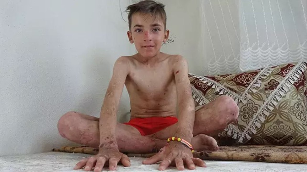 Deri hastalığı hayatını kâbusa çevirdi! Arkadaş...